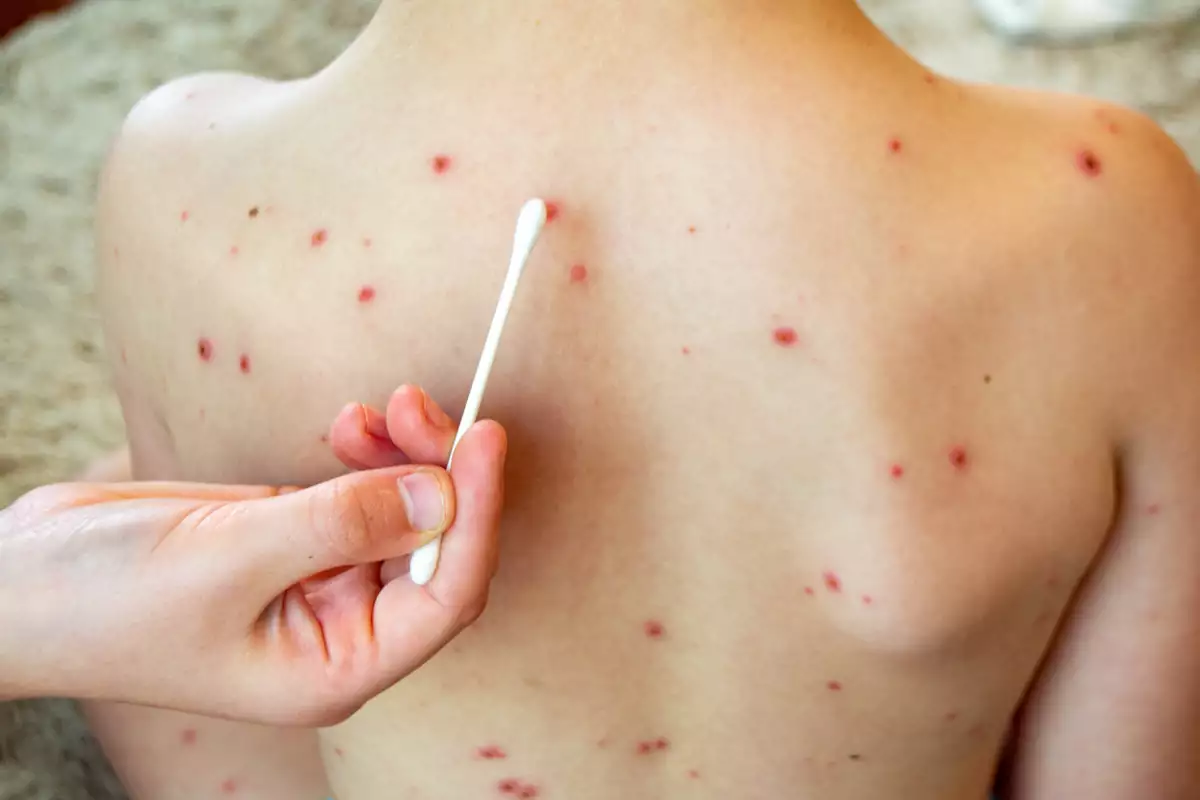 QUERÉTARO REGISTRA 21 CASOS DE SARAMPIÓN